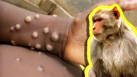 猴痘在中国传播的可能性大不大,猴痘病在2022年会不会爆发在中国